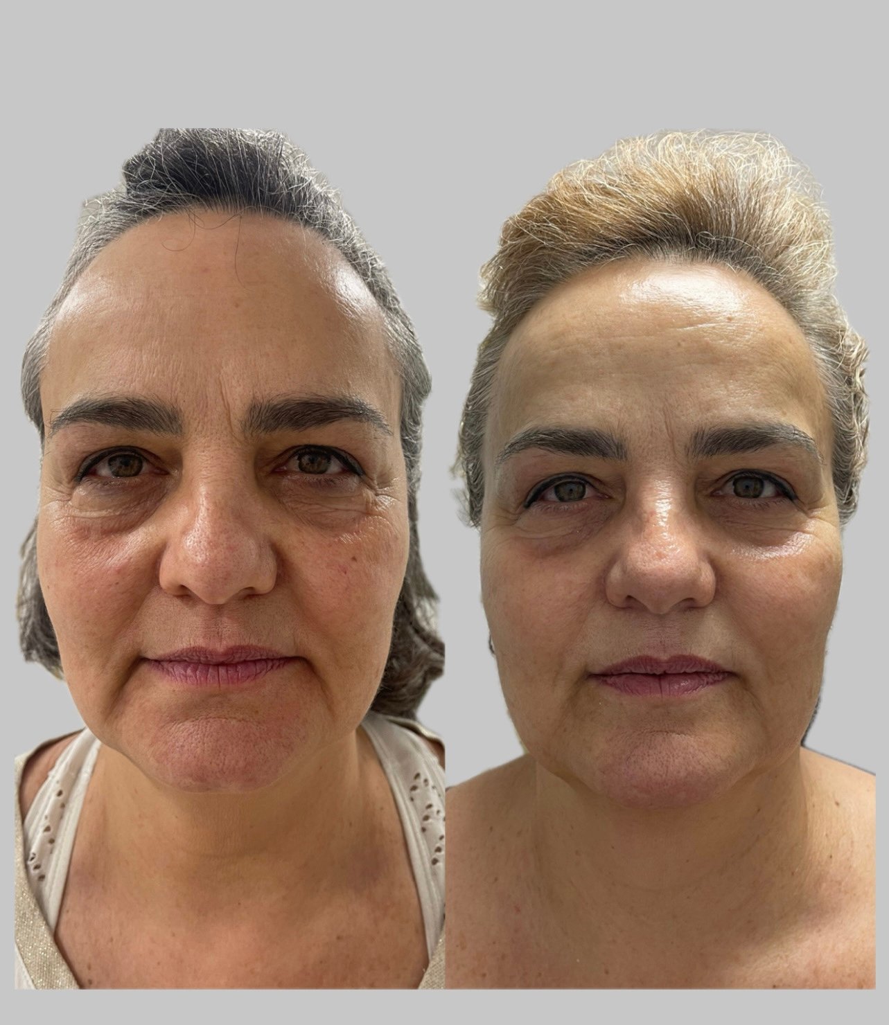 Resultado de tratamento 13